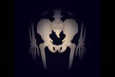 hip replacement recovery time for elderly